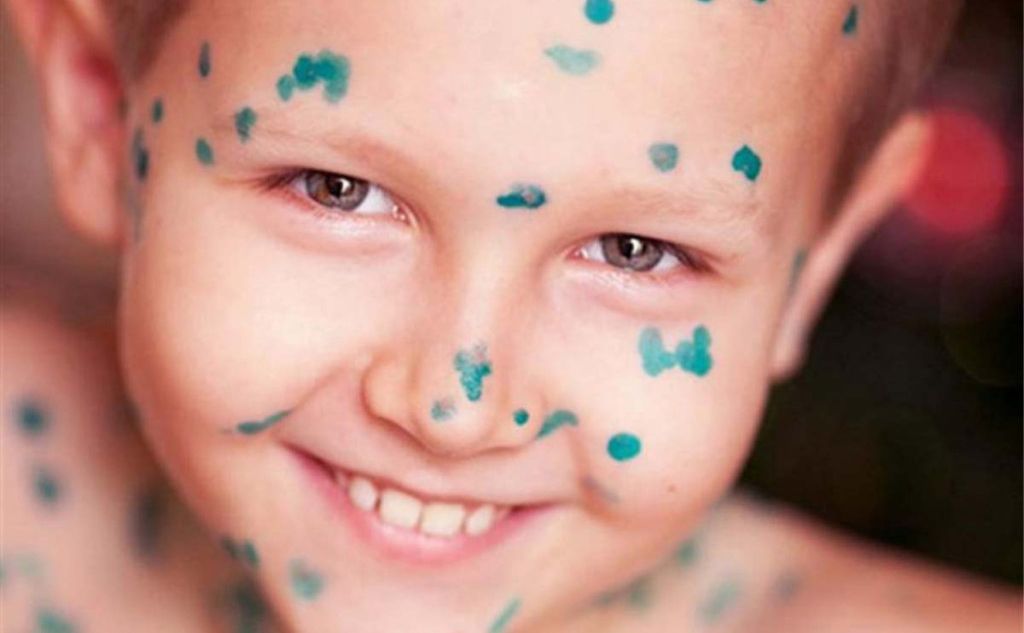 На Полтавщині зросла кількість хворих на вітряну віспу