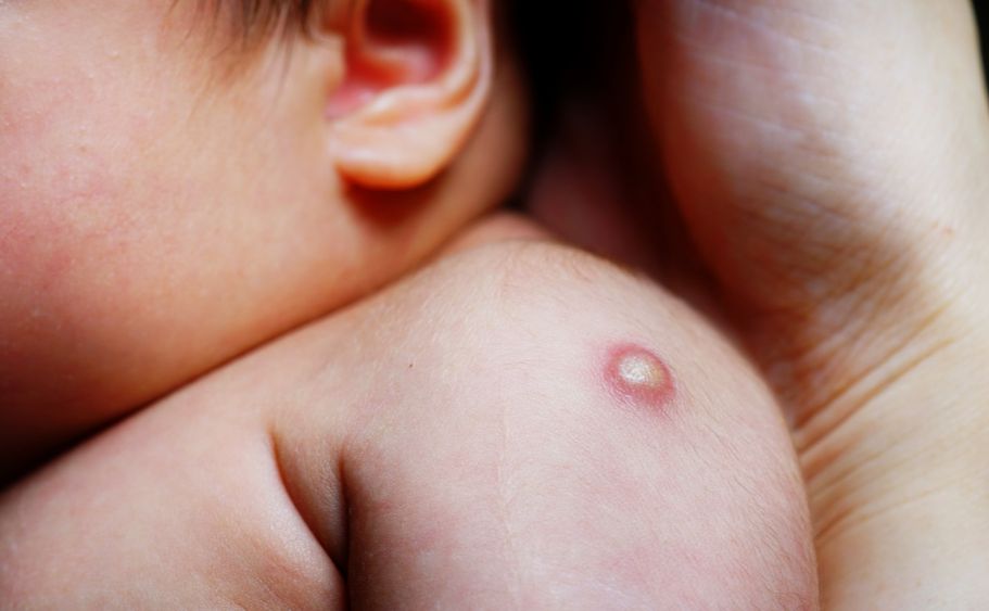 Вакцина БЦЖ — по-новому