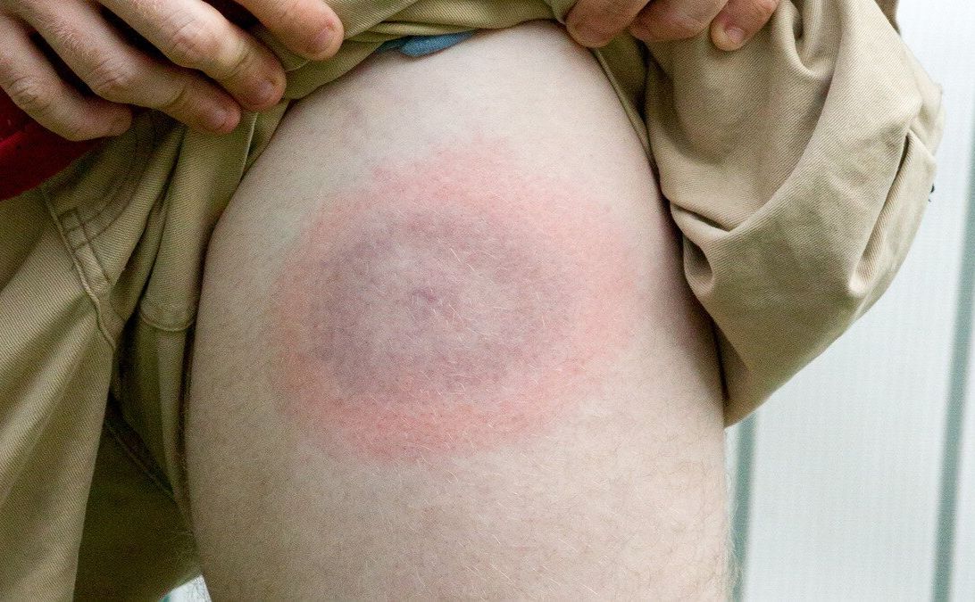 У Полтавській області набирає обертів хвороба Лайма